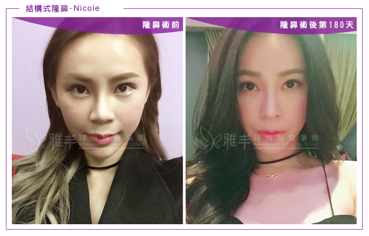 nicole結構式隆鼻術後180天,曾文尚