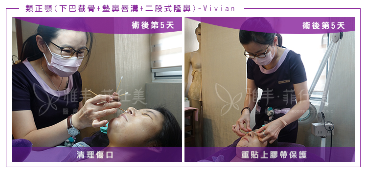 VIVIAN隆鼻墊鼻唇溝下巴截骨術後第5天