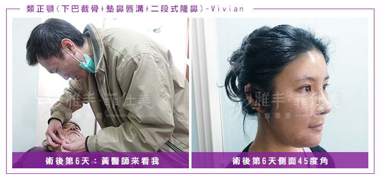 VIVIAN隆鼻墊鼻唇溝下巴截骨術後第6天