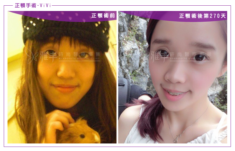 陳怡傑戽斗正顎案例VIVI,正顎術後第270天