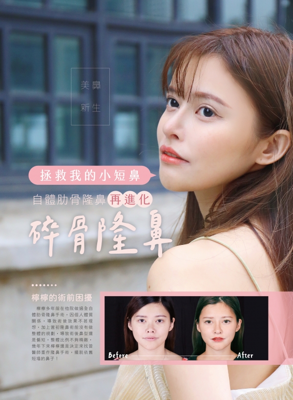 自體肋骨隆鼻再進化，碎骨隆鼻