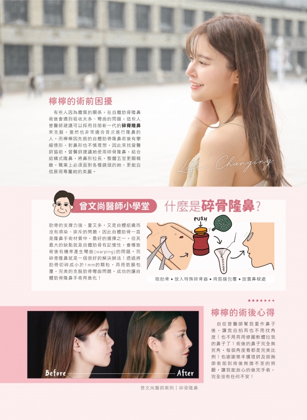 自體肋骨隆鼻再進化，碎骨隆鼻