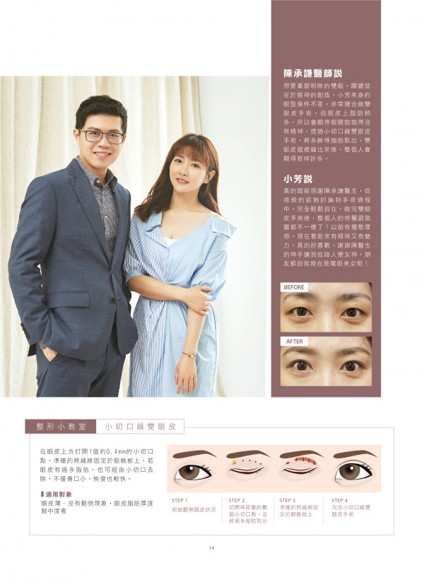 78期美人誌｜陳承謙雙眼皮案例2