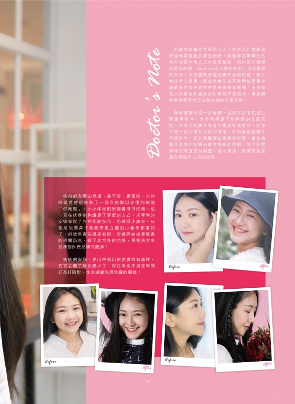 雅丰美人誌81期｜陳承謙醫師-結構式隆鼻案例2