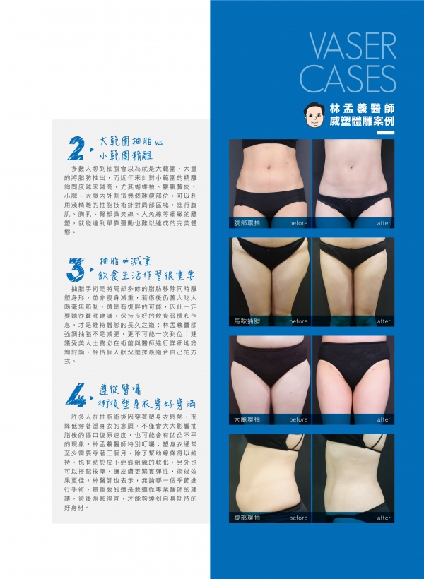 雅丰美人誌82期｜林孟羲醫師-脂雕美學，關於抽脂你必須知道的四件事2