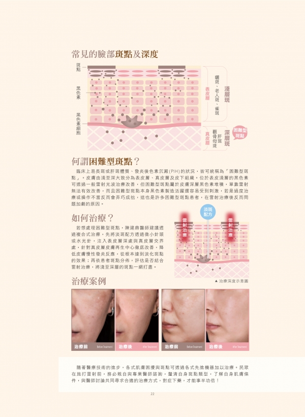 雅丰美人誌82期｜陳建鼎醫師-困難型斑點治療2