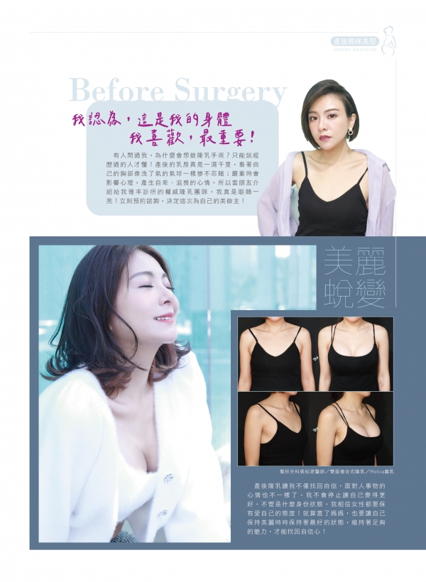 雅丰美人誌84期｜張松源醫師-MOTIVA隆乳案例2