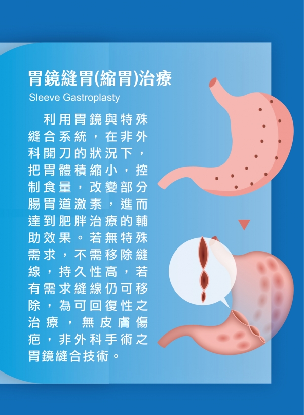 雅丰美人誌85期｜肥胖治療新領域—胃鏡減重治療4
