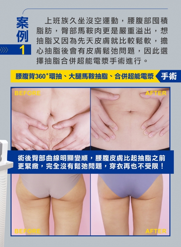 雅丰美人誌85期｜超能電漿雅丰案例分享3