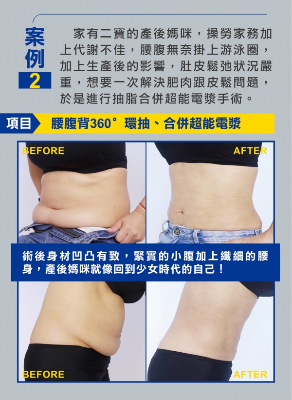 雅丰美人誌85期｜超能電漿雅丰案例分享4
