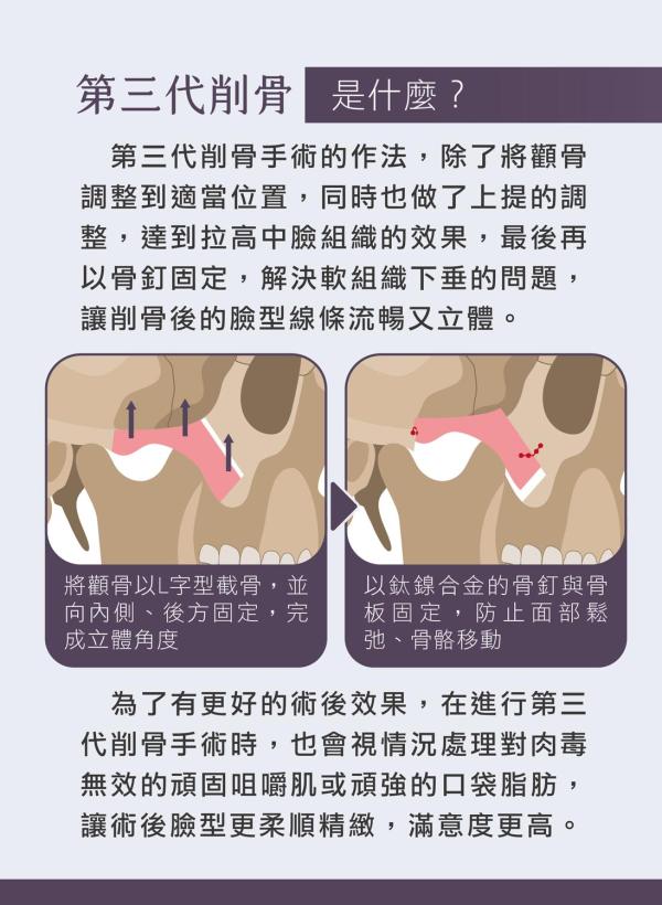 雅丰美人誌88期｜第三代削骨，骨頭與軟組織的完美平衡3