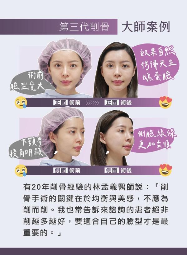 雅丰美人誌88期｜第三代削骨，骨頭與軟組織的完美平衡4
