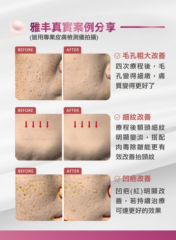 雅丰美人誌88期｜超妍水光注射，自體生長因子4