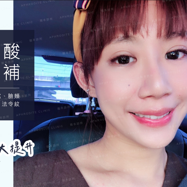 玻尿酸填補凹臉 雅丰微整形案例angel