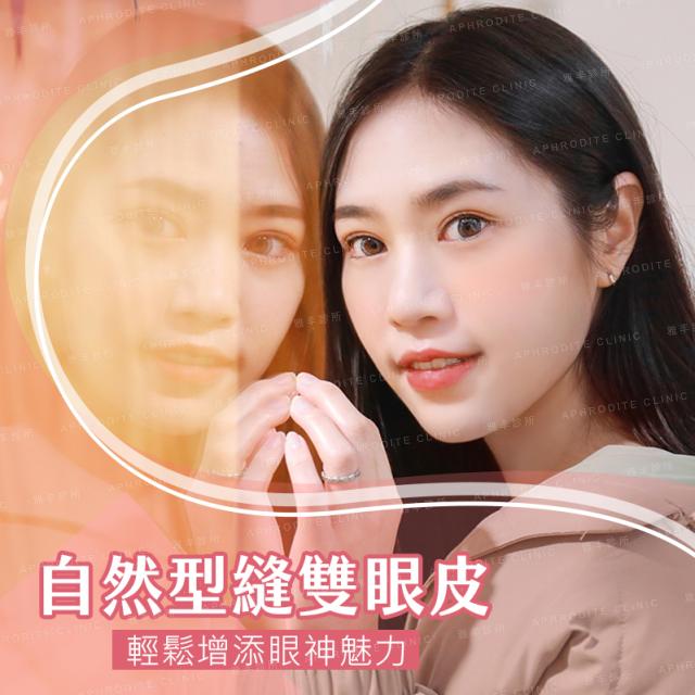 【眼部整形】自然型縫雙眼皮 輕鬆增添眼神魅力 張松源醫師案例