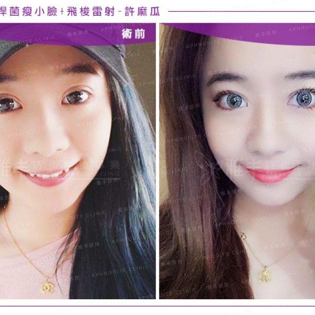 botox+laser_hsu_09.jpg