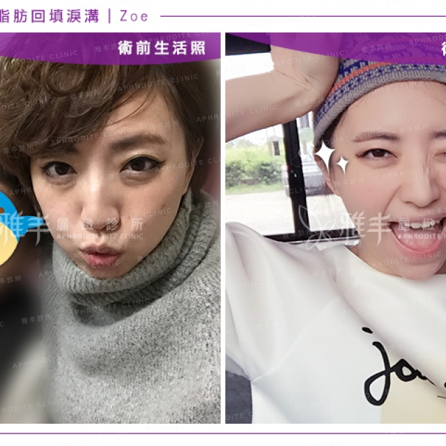 eye_zoe_live_compare2.jpg