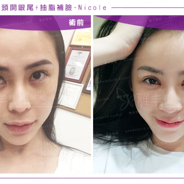 fatgraft+canthoplasty_nicole_33.jpg
