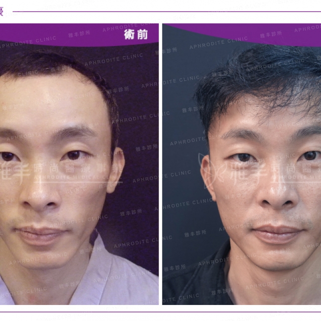 hair transplant_15_1.jpg