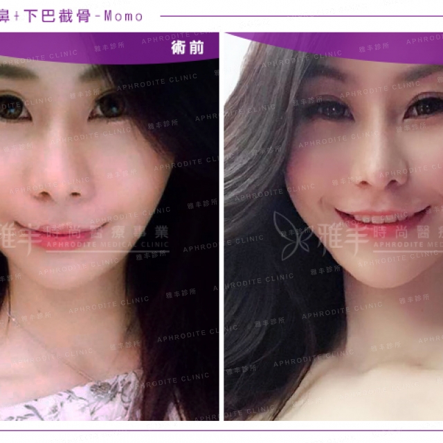 nosalplasty_momo_21.jpg