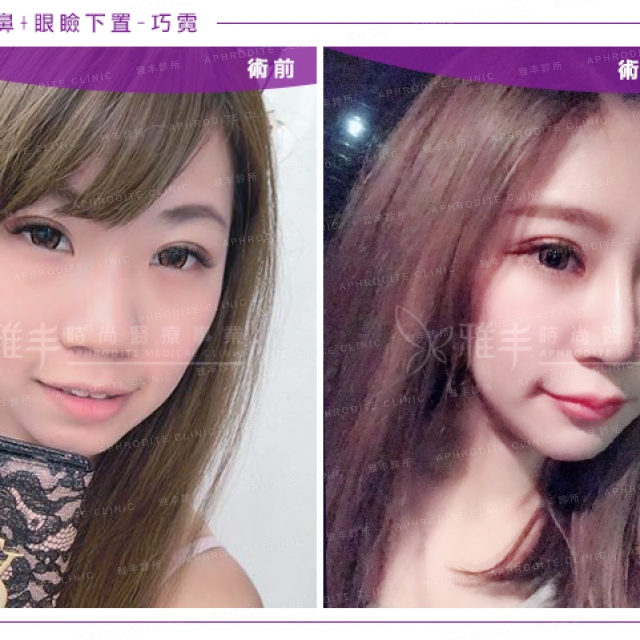 rhinoplasty_ni_10.jpg