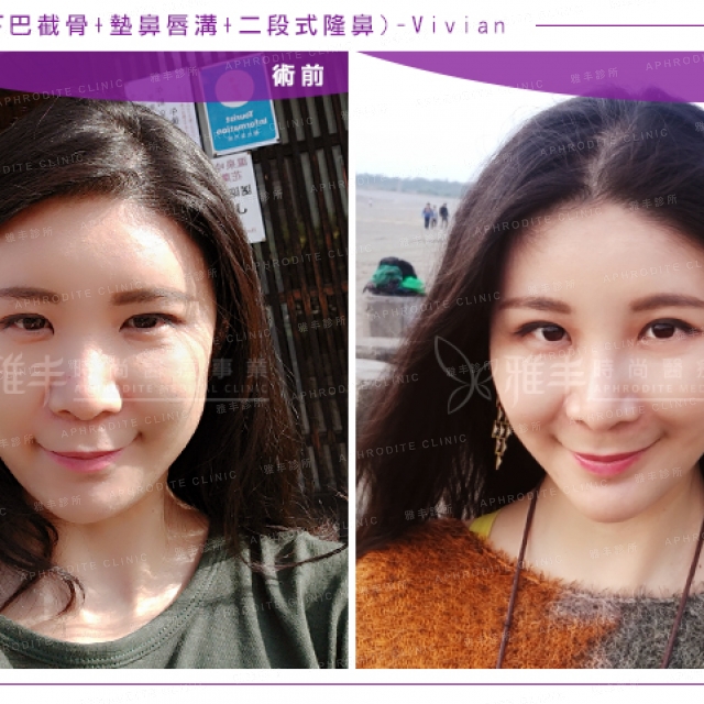 similarorthognathic_vivian_24.jpg