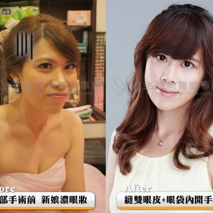 02怡婷雙眼皮作圖_0.jpg