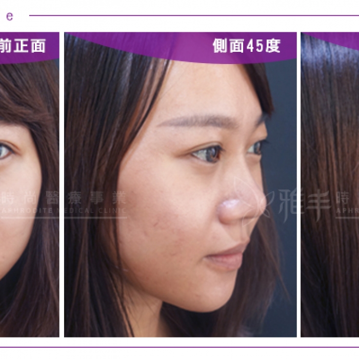 2partrhinoplasty_feebie03.jpg