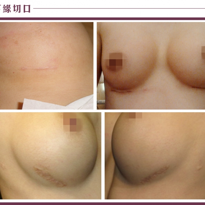 _乳房下緣切口.jpg