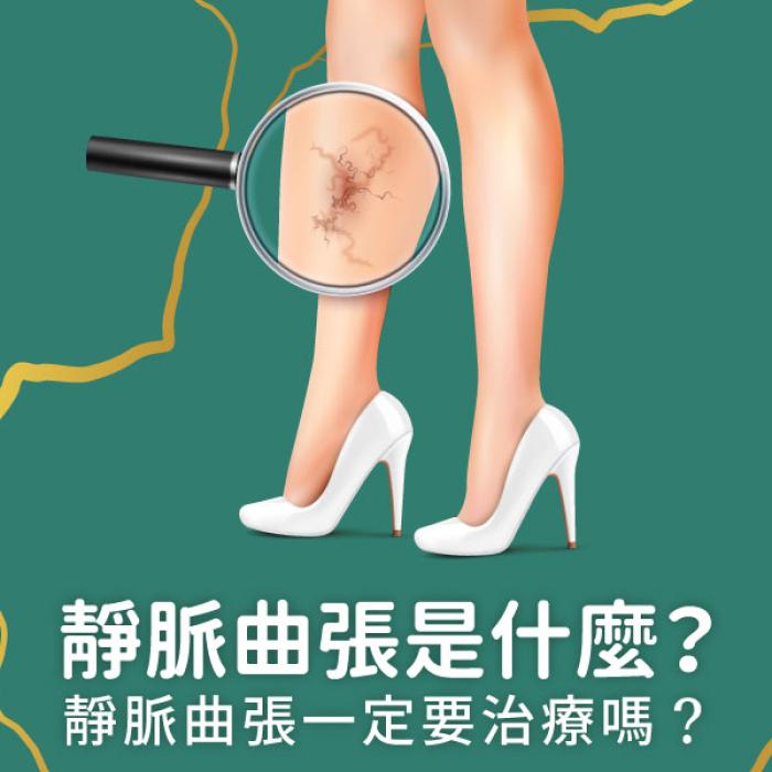 靜脈曲張是什麼?靜脈曲張一定要治療嗎?