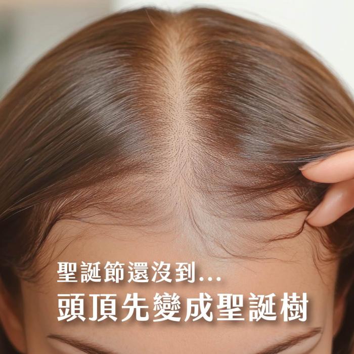 女性雄性禿是什麼？從頭頂禿髮徵兆到有效治療全解析