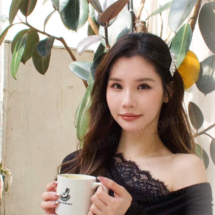美人尖漩渦FUE不剃髮植髮_黃智威醫師