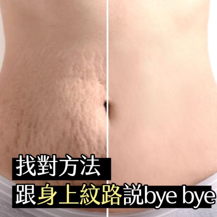 找對方法，跟身上紋路說bye bye 皮膚專科黃靜雯醫師│雅丰美膚診所