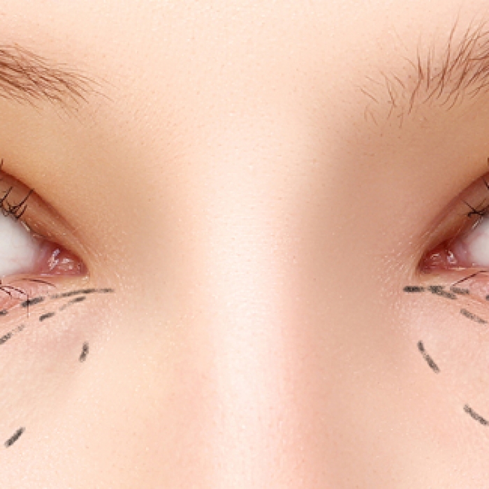column_20150720_drlin_eye bags.jpg