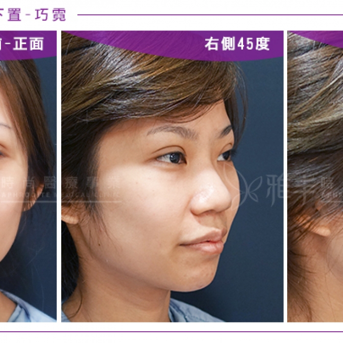 rhinoplasty_ni_03.jpg