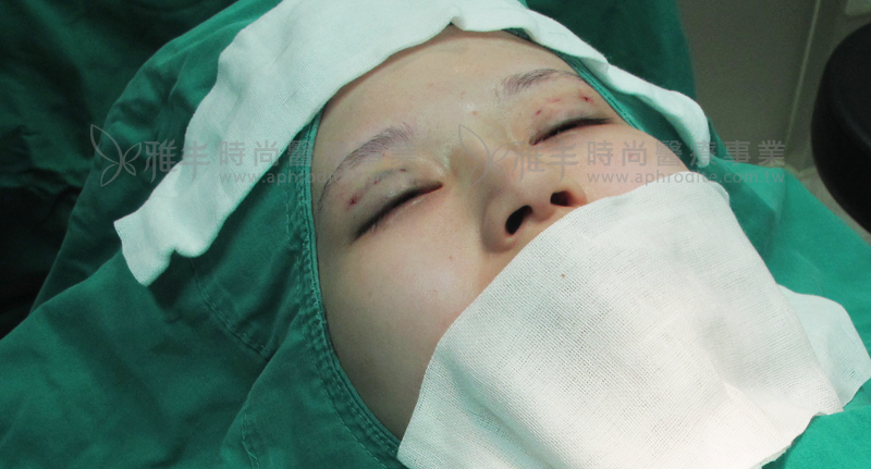 縫雙眼皮案例lala手術照03,雙眼皮推薦
