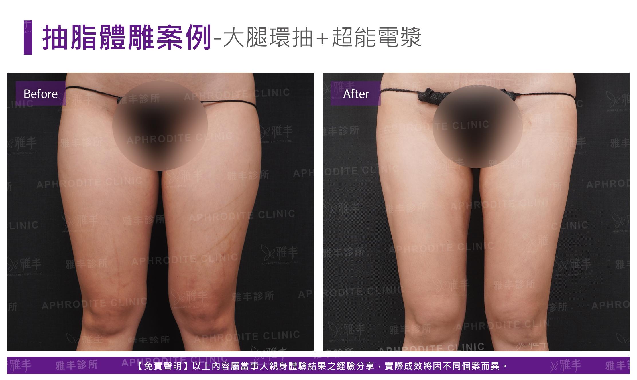 大腿環抽+超能電漿(Case6-F)
