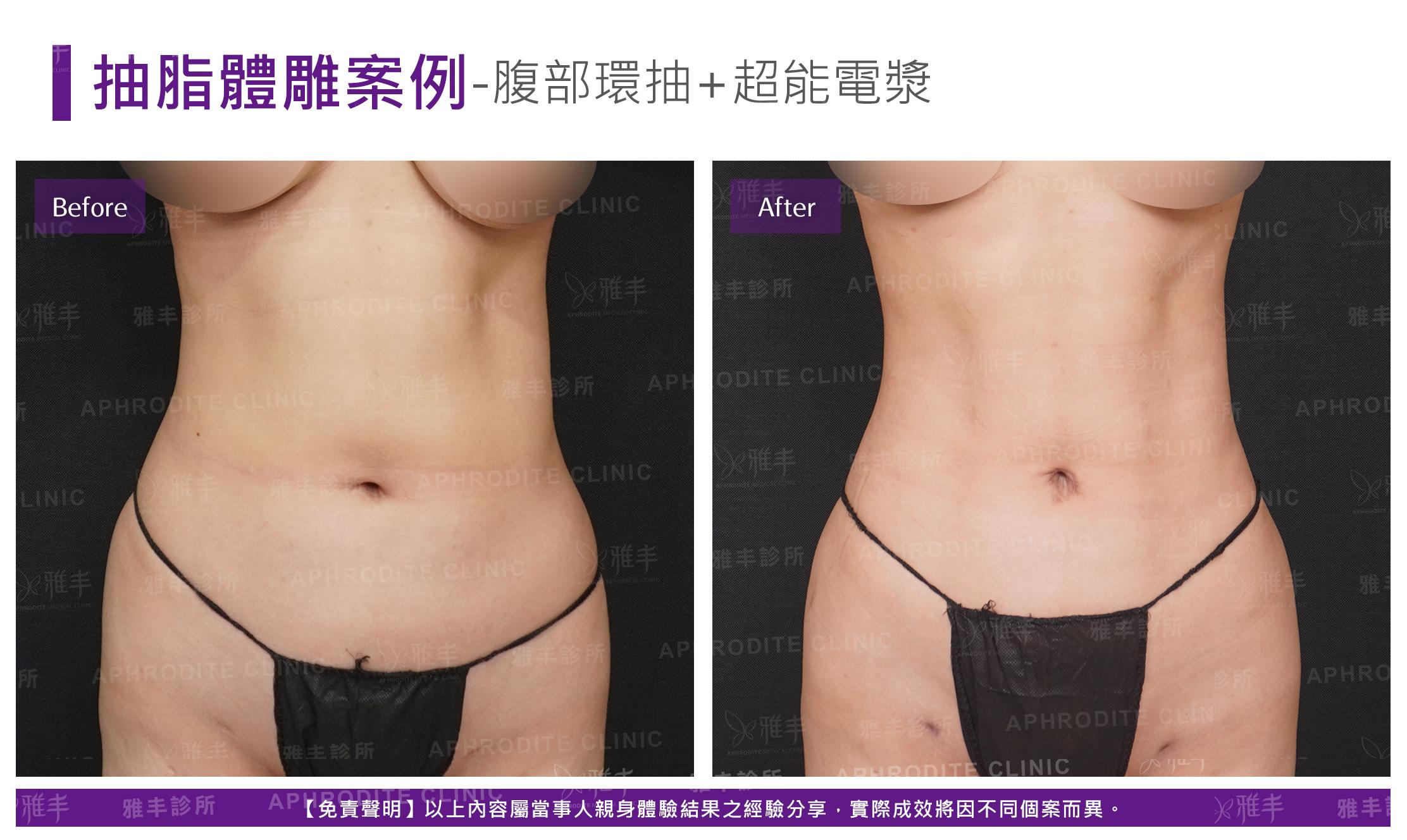 腹部環抽+超能電漿(Case2-F)