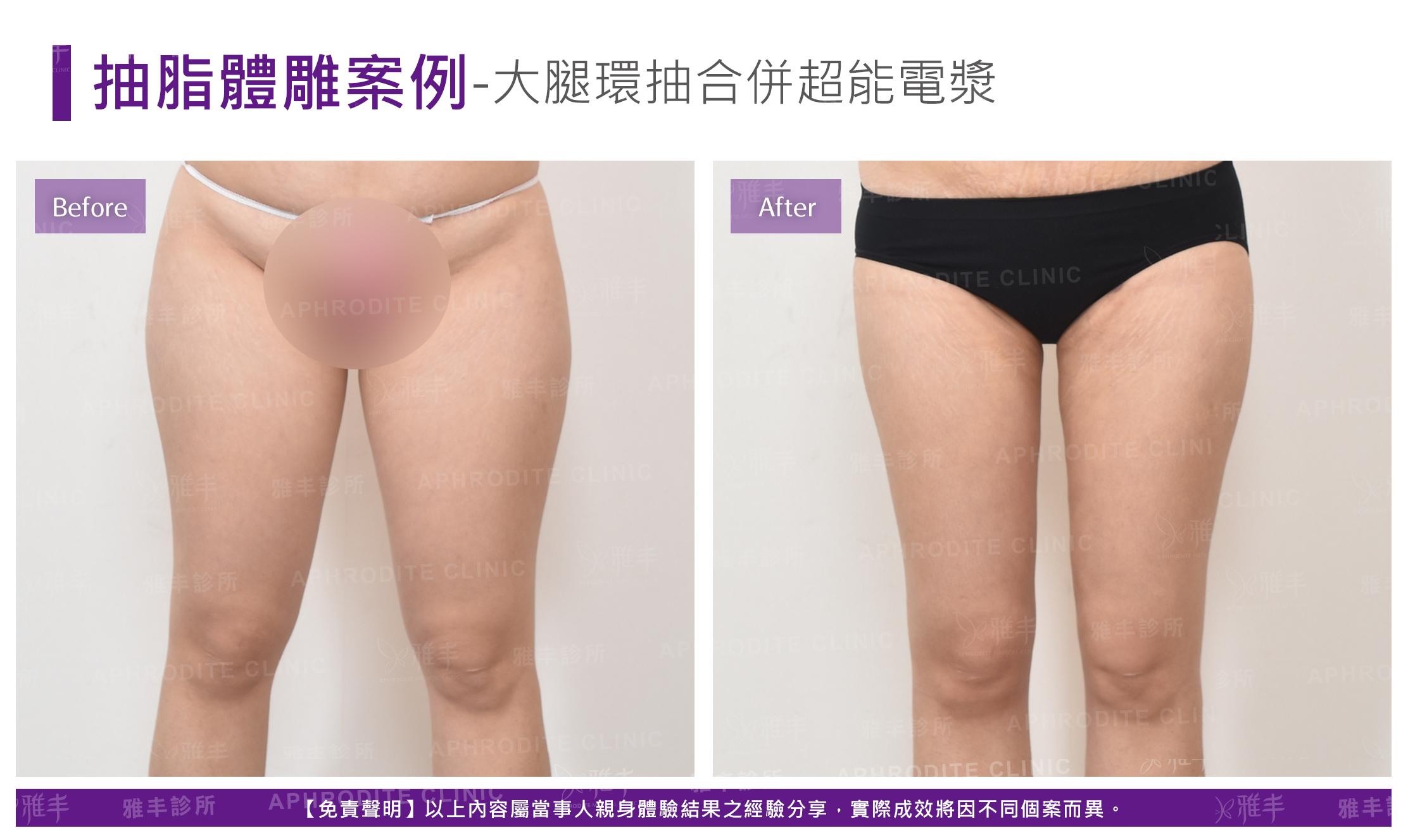 大腿環抽+超能電漿(Case4-F)