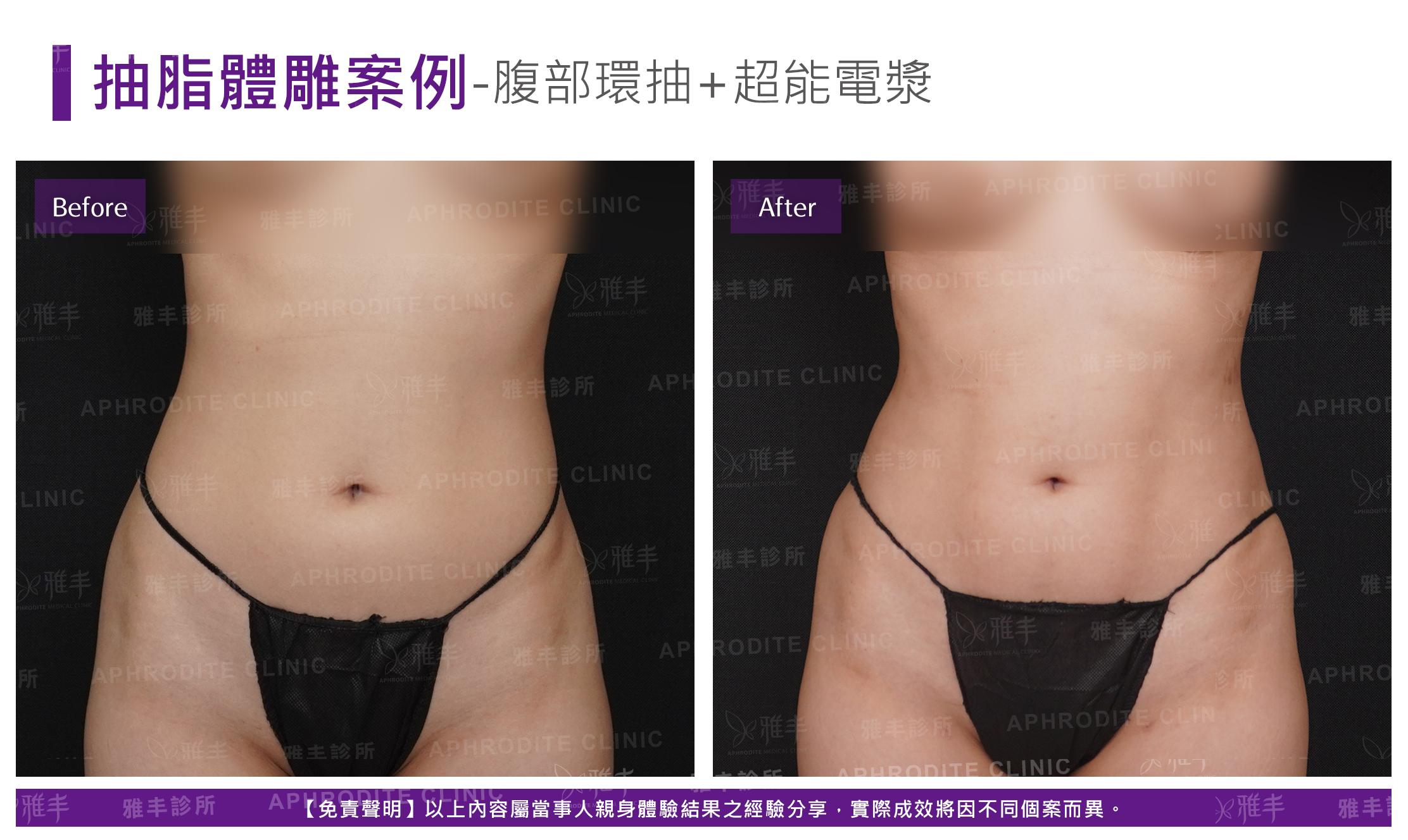 腹部環抽+超能電漿(Case3-F)