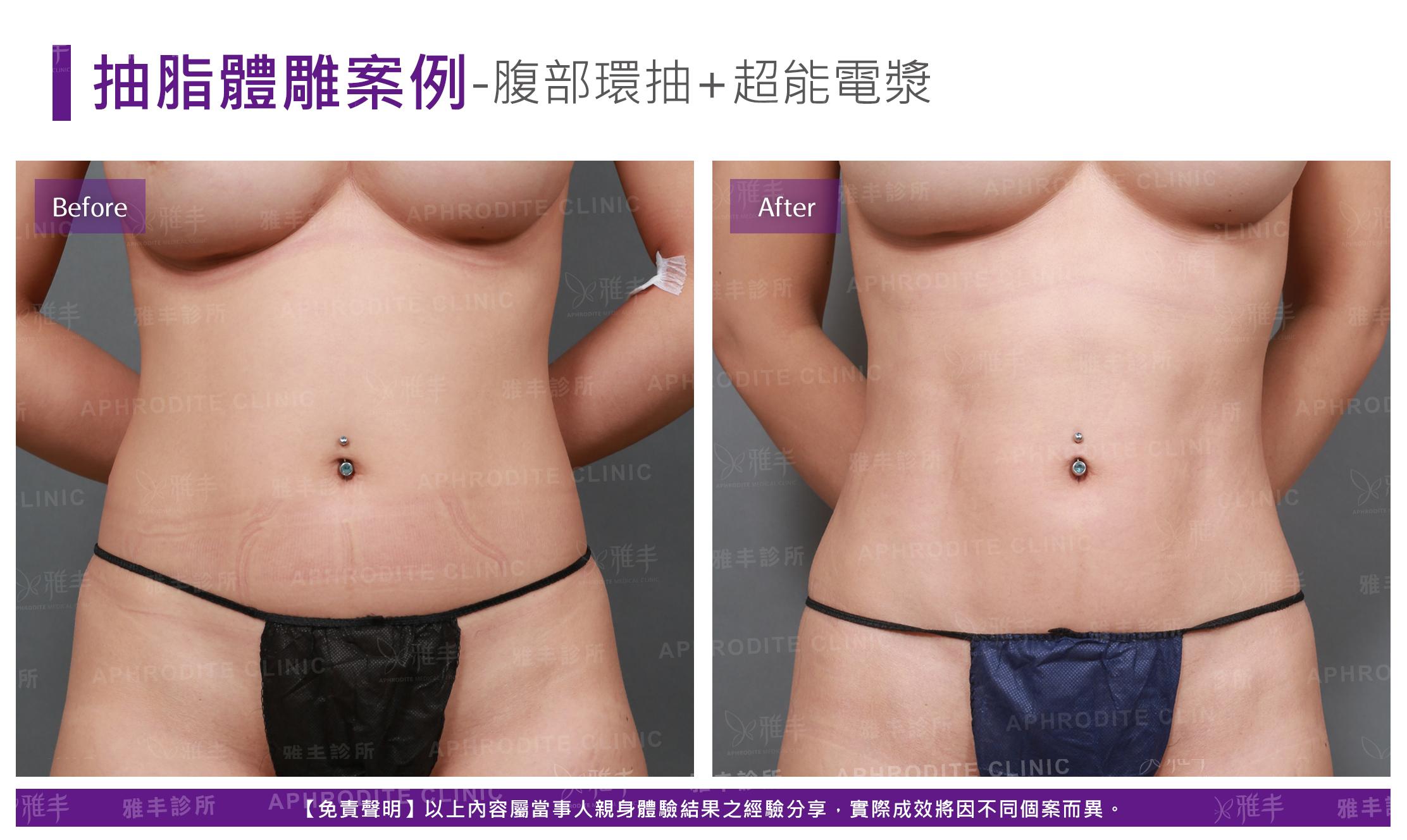 腹部環抽+超能電漿(Case1-F)