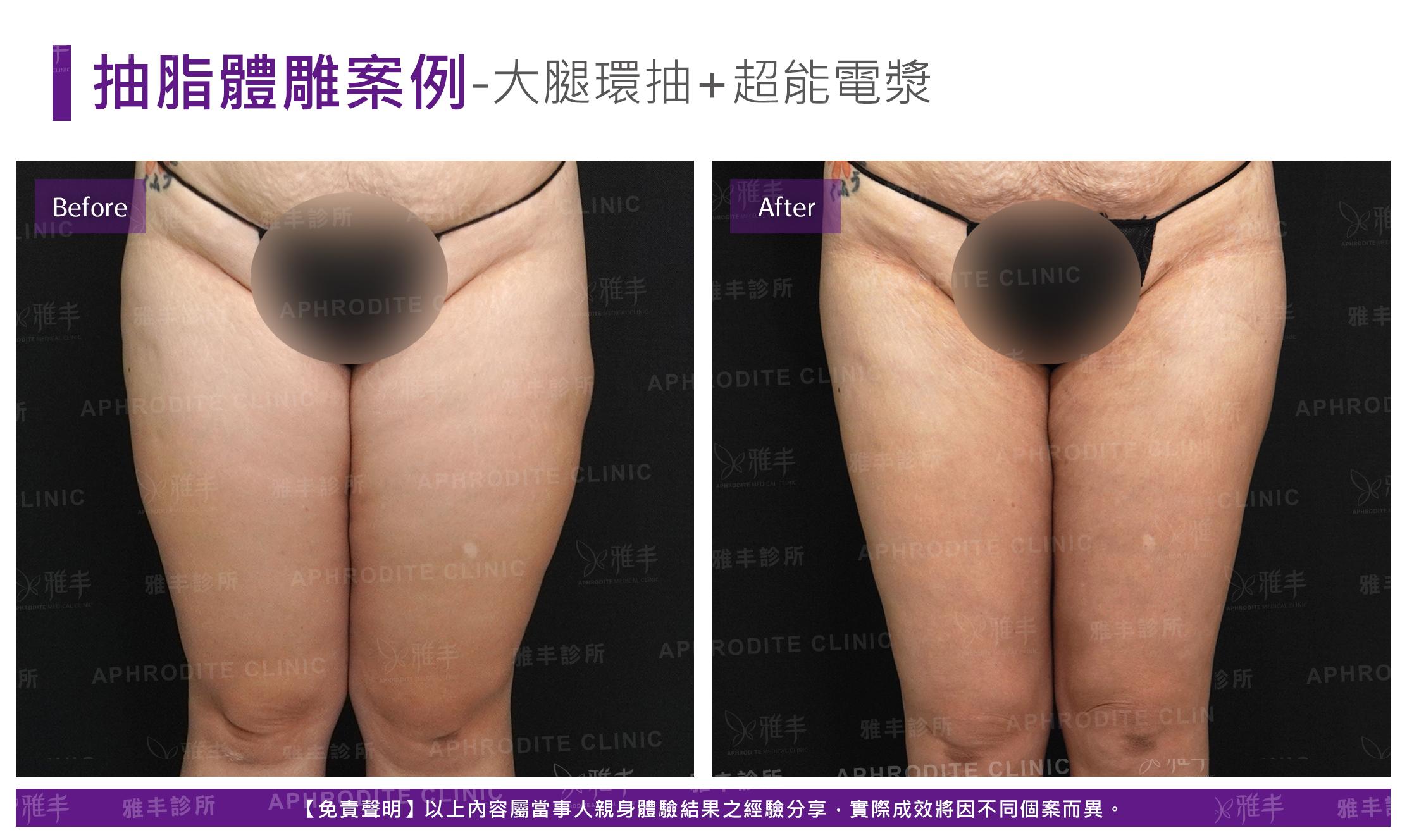 大腿環抽+超能電漿(Case5-F)
