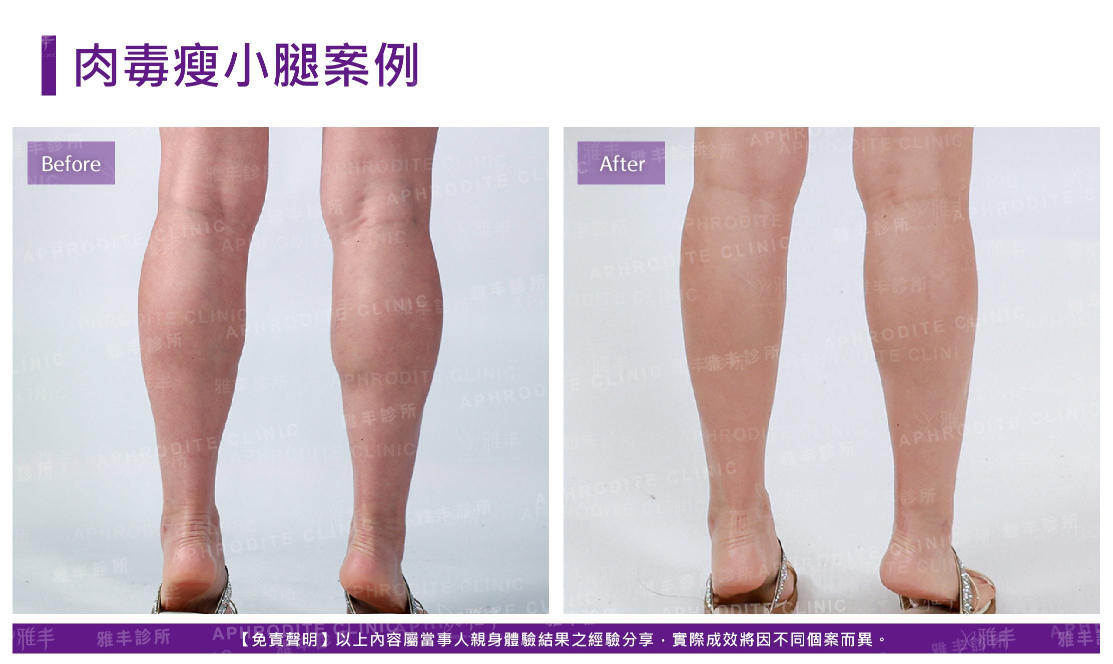 肉毒桿菌-case09-B
