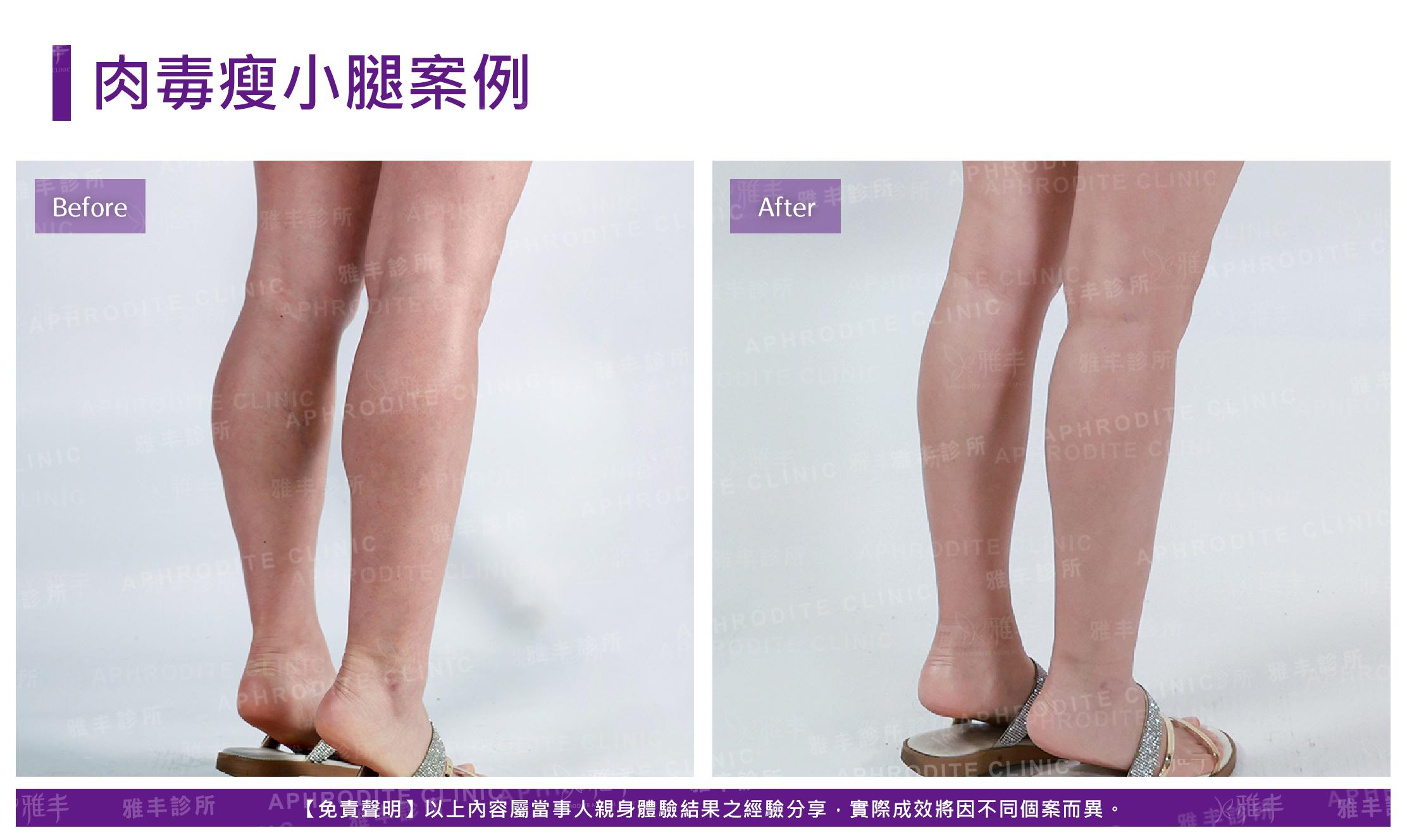 肉毒桿菌-case09-R45