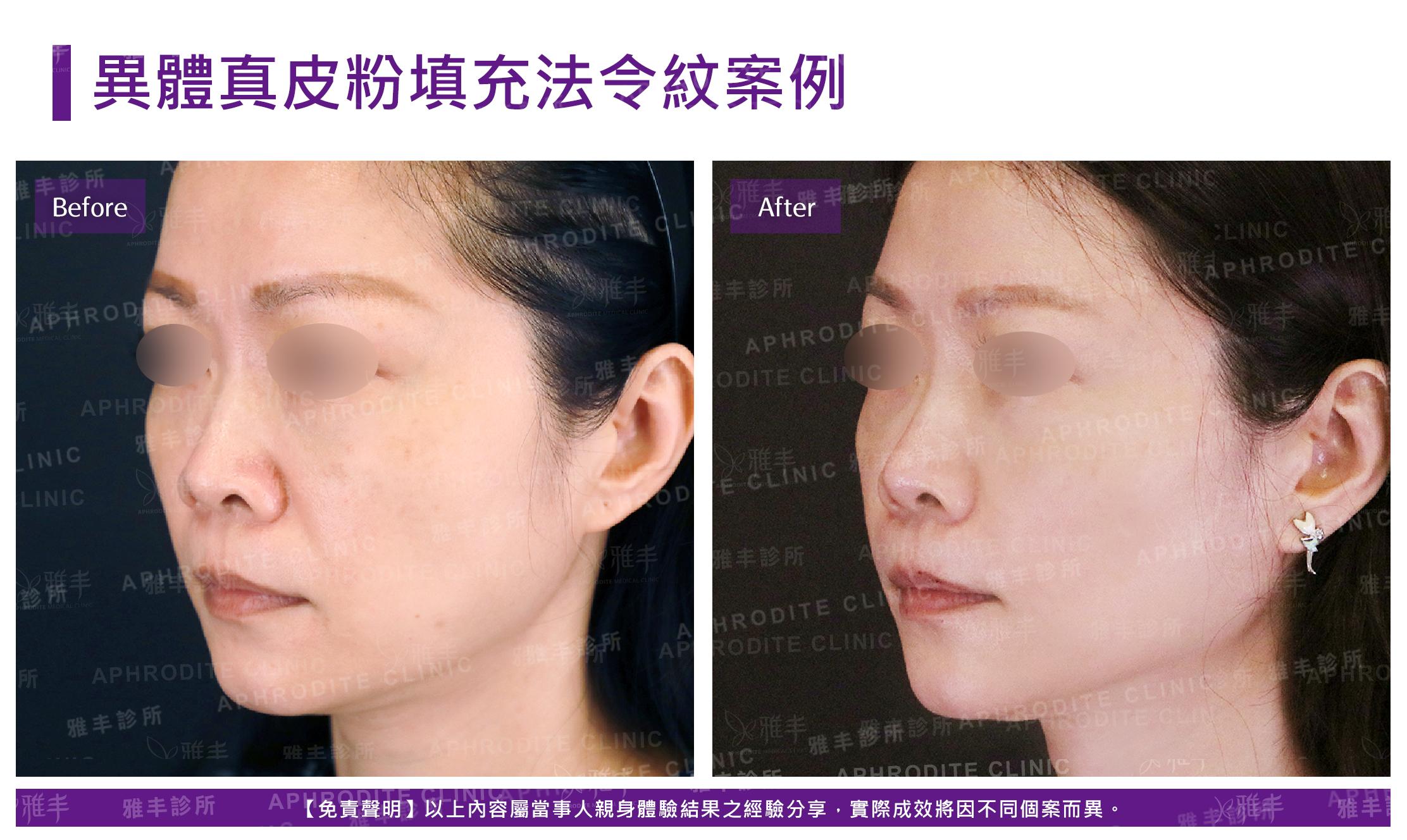異體真皮粉填充法令紋-case06-L45
