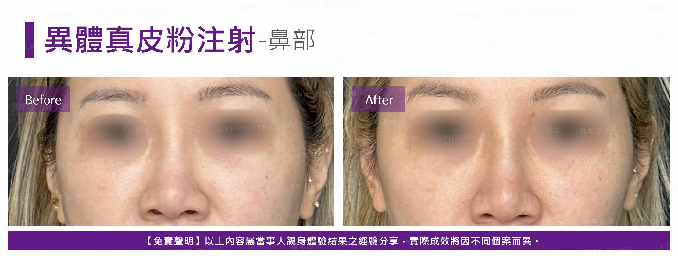 異體真皮粉注射-case07-F.jpg
