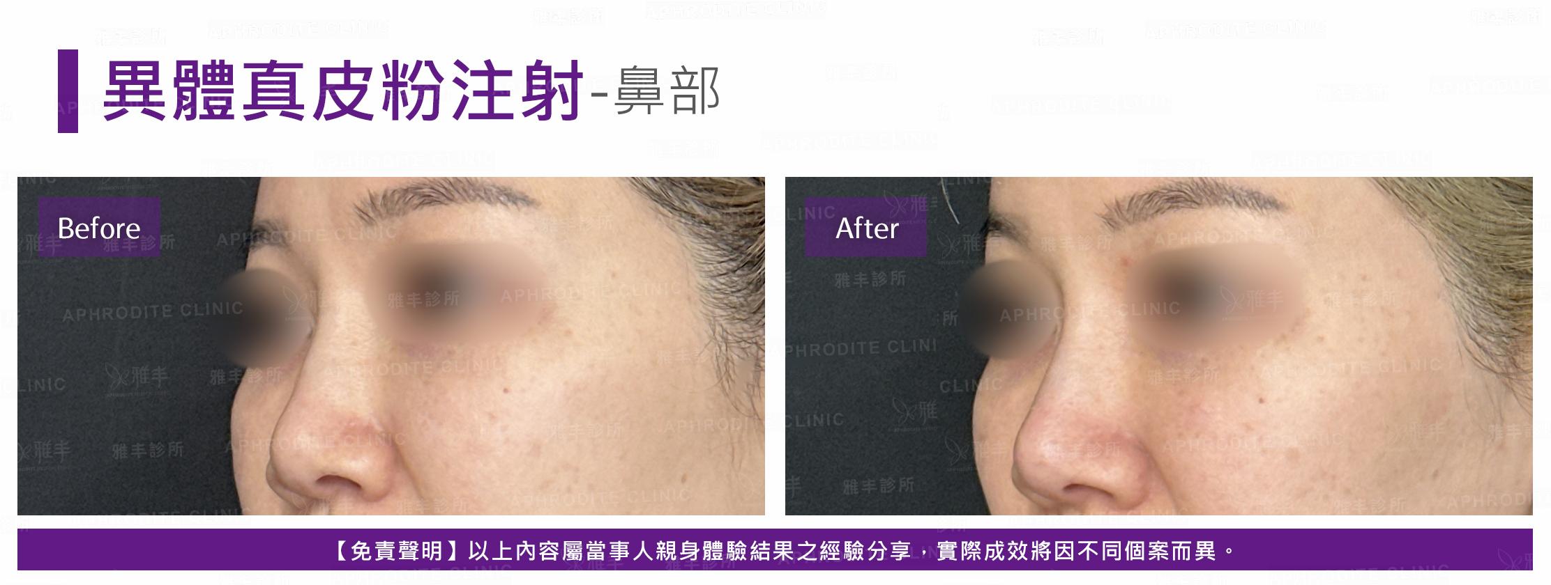 異體真皮粉注射-case07-L45.jpg