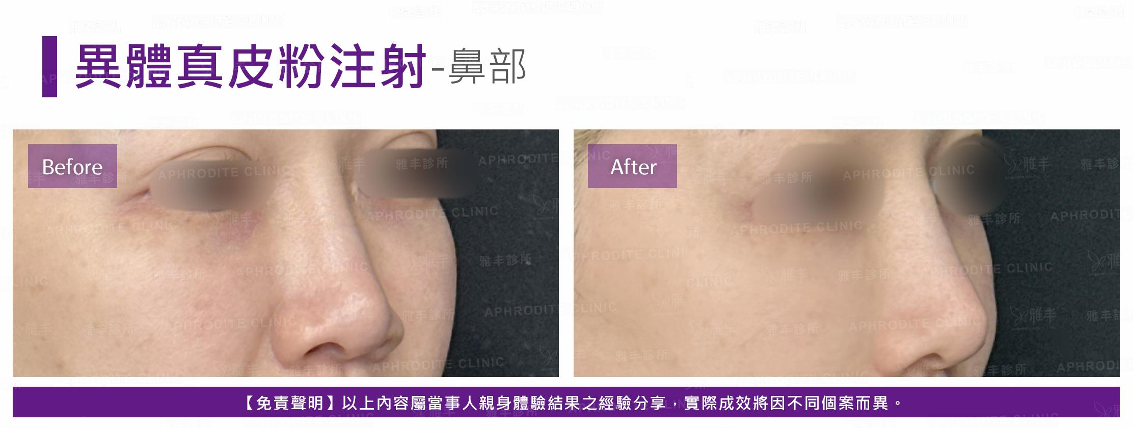 異體真皮粉注射-case07-R45.jpg