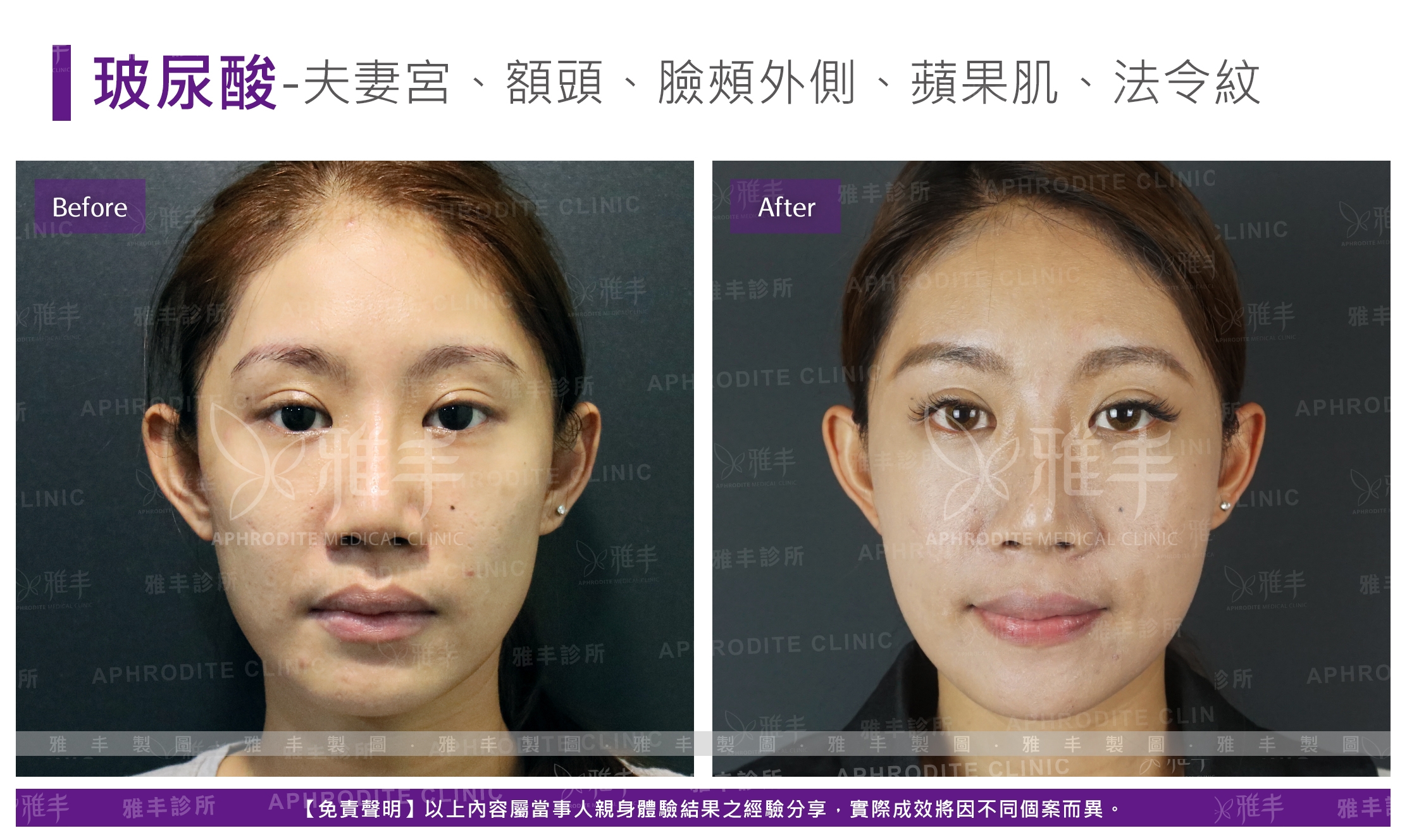 玻尿酸-夫妻宮、額頭、臉頰外側、蘋果肌、法令紋(Case5-F)