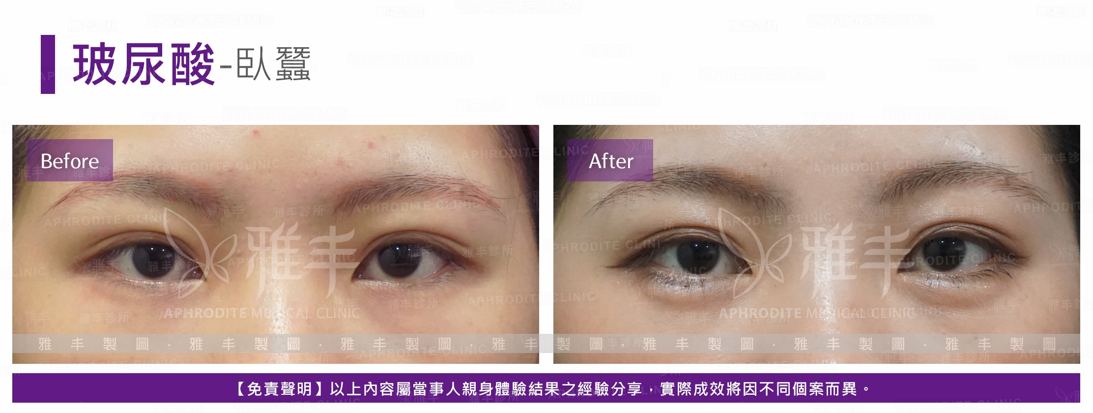 玻尿酸-臥蠶(Case7-F)